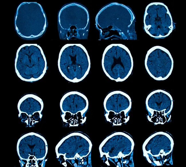 znachenie svoevremennoy diagnostiki i lecheniya sotryaseniy mozga